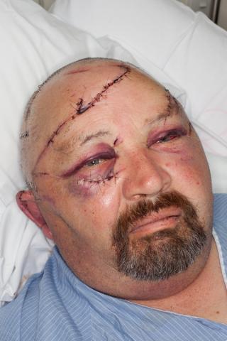 Highway Patrol officer Bruce Mellor underwent surgery to treat lacerations to his face